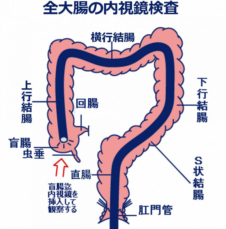 大腸癌の発生頻度