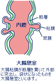 大腸憩室炎