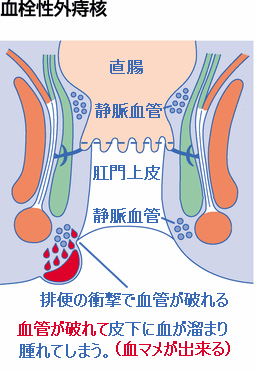 血栓性痔核 