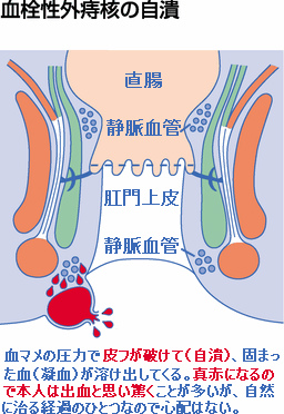 血栓性痔核 