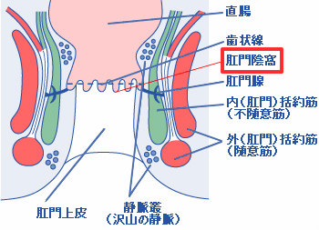 肛門陰窩炎（こうもんいんかえん）