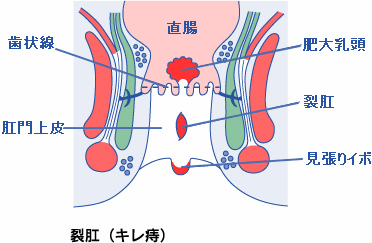 裂肛（レッコウ）（切レ痔）