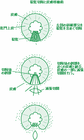 裂肛切除と皮膚移動術