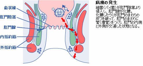 痔瘻（ジロウ）（穴痔）