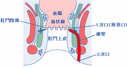 痔瘻（ジロウ）（穴痔）