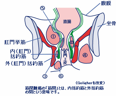 肛門周囲膿瘍