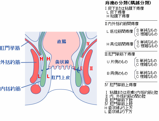 痔瘻の分類