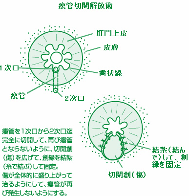 瘻管切開開放術