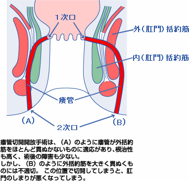 瘻管切開開放術