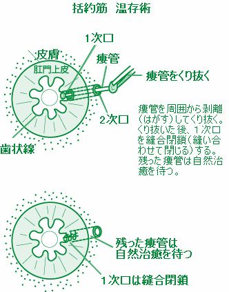 括約筋温存術