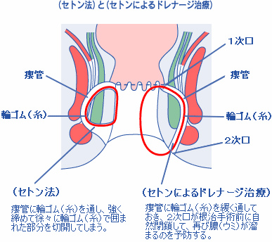 セトン法