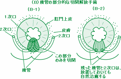 1次口および限局的な瘻管の切開開放手術