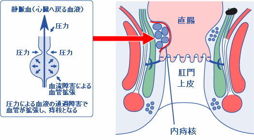 痔核（ジカク）（イボ痔）