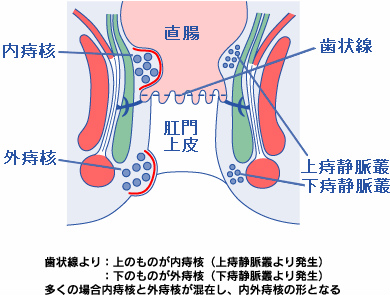 内痔核と外痔核