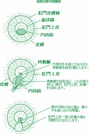 結紮切除半閉鎖手術