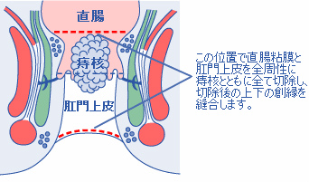 ホワイトヘッド氏法手術