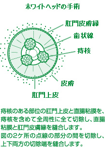 ホワイトヘッド氏法手術