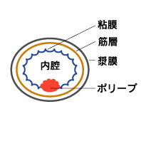 大腸ポリープとは