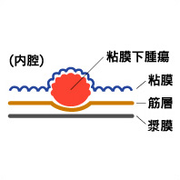 大腸ポリープとは