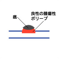 大腸ポリープとは