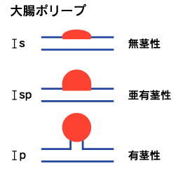 大腸ポリープと表面型病変