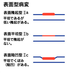 
表面型病変