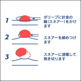  大腸内視鏡によるポリープ切除術（切除は無痛です）