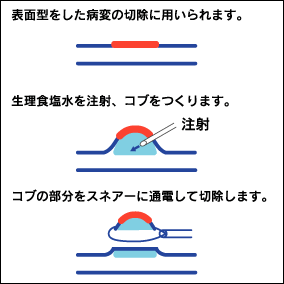 大腸内視鏡による粘膜切除術