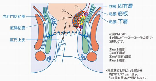 アルタ治療