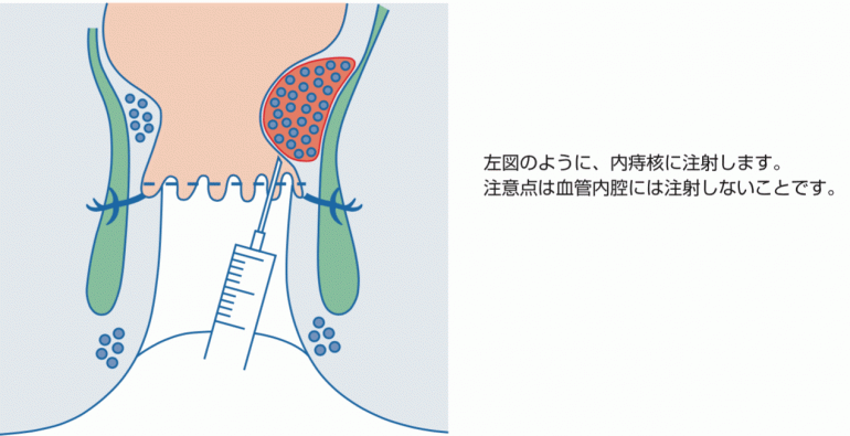 ALTA治療（別名：ジオン治療）