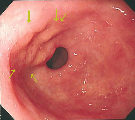 胃の出口（幽門）付近です。<br>
多少デコボコしている部分が病変部です。