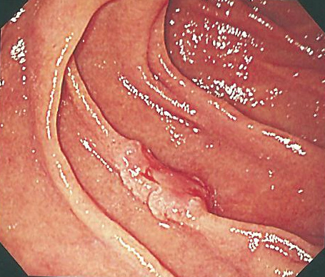 十二指腸の早期癌